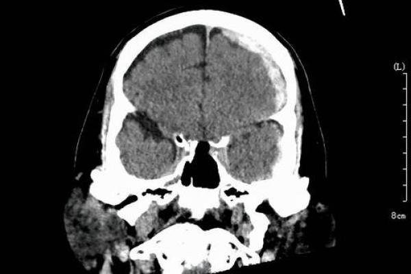 脑出血：命悬一线的危机与挑战，知晓早期症状，才是生的希望