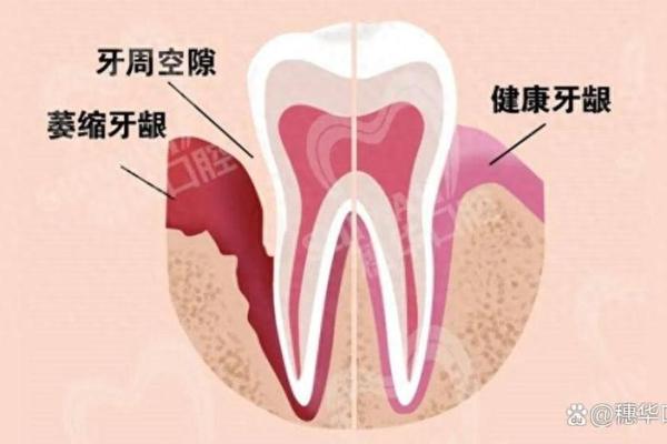 牙龈疙瘩的真相：解析与预防方法，健康口腔从现在开始