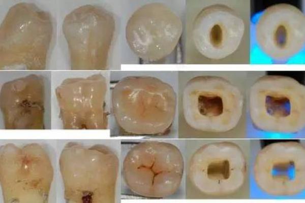 牙齿与命运：解读牙齿数量背后的文化象征与人生哲学